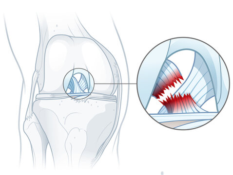 Anterior cruciate ligament tear. Knee injury. Medically illustration