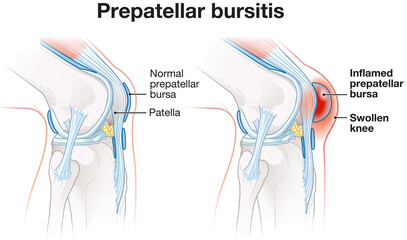 Prepatellar bursitis.Labeled medically illustration