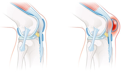 Obraz na płótnie Canvas Prepatellar bursitis. Inflammation of the bursa in front of the kneecap. Illustration