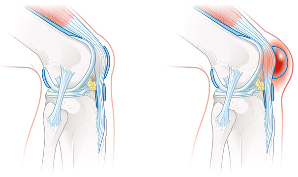 Prepatellar bursitis. Inflammation of the bursa in front of the kneecap. Illustration