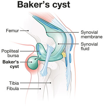 Baker's cyst of the knee. Medically labeled illustration
