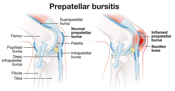 Prepatellar bursitis. Inflammation of the bursa in front of the kneecap. Labeled medically illustration