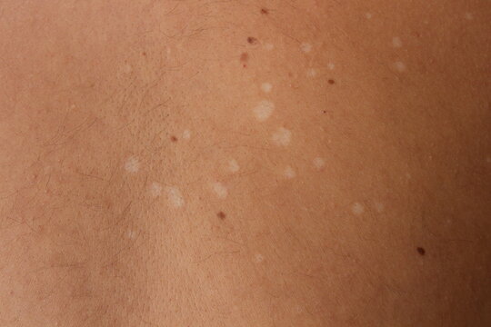Understanding Tinea Versicolor: Managing and Treating Pityriasis Versicolor