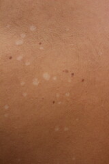 Understanding Tinea Versicolor: Managing and Treating Pityriasis Versicolor