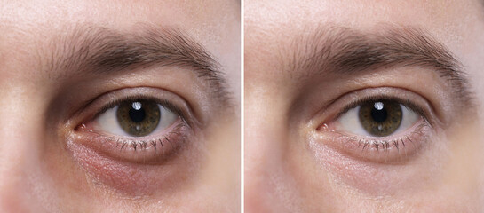 Collage with photos of man with dark circle under eye before and after treatment, closeup