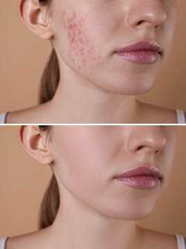 Acne problem. Young woman before and after treatment on beige background, closeup. Collage of photos