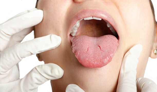 Young woman with geographical tongue. Migratory glossitis.