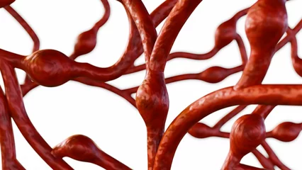 Fotobehang 3d rendering of microaneurysms (MAs), these are small swellings of blood vessels in the retina © Love Employee