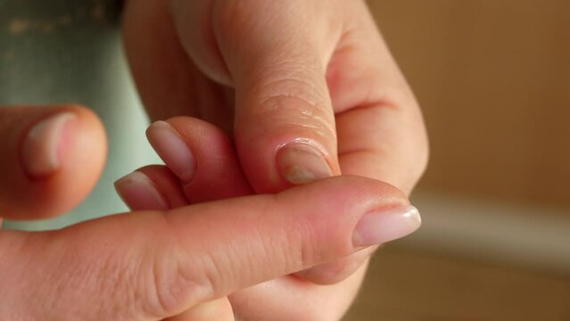 Close-up of a woman applying healing oil to a damaged detached nail, onycholysis. Monarda oil. Onycholysis is the detachment of the nail from the nail bed.
