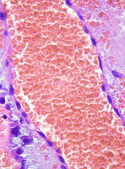 Large hemorrhage inside the atrial myxoma, red red blood cells and purple myxoma cells are visible....