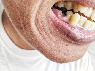 Obraz premium cavities and yellow teeth in humans