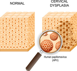 Cervical dysplasia and Human papillomavirus infection
