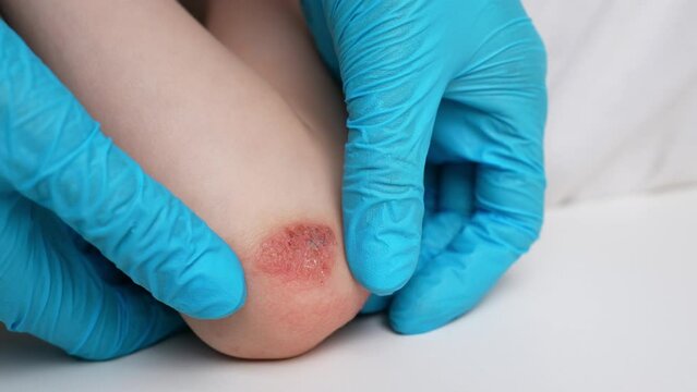  Doctor examines reddened, inflamed areas with scabs on child elbow, close-up. Child suffers from allergy attacks and dermatitis. Dermatological skin diseases concept