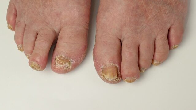 Toenail fungus. Nails affected by a fungal infection. Onycholysis of nails, paramedicine, medical pedicure, aging problems