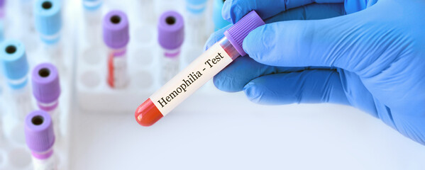 Doctor holding a test blood sample tube with Hemophilia test on the background of medical test tubes with analyzes.