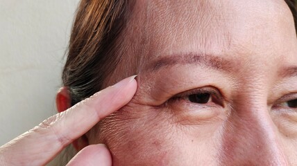 close up of the flabbiness and wrinkle beside the eyelid, Flabby skin and loose, dark spots and blemish, eyelid and ptosis on the face, health care and beauty concept.