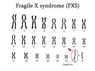 The Karyotype of Fragile X syndrome (FXS) is a genetic disorder of fragile on chromosome x caused by malfunction of gene FMR-1.  