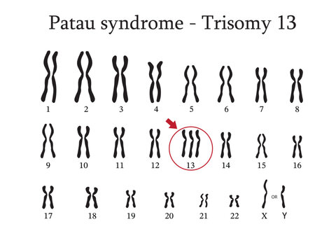 Karyotype of Patau syndrome also known as trisomy 13, is a genetic disorder caused by the presence of all or part of a third copy of chromosome 13.