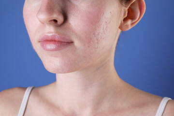 Young woman with acne problem on blue background, closeup