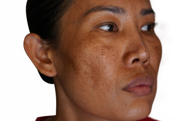 Freckles and Spot melasma pigmentation skin facial treatment over Asian woman face.
