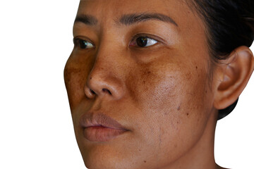 Freckles and Spot melasma pigmentation skin facial treatment over Asian woman face.