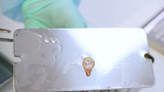 PRF membrane in dental surgery. Dentist's hand open metal PRF box and taking PRF membrane. Platelet rich fibrin membrane prepared from the patient's blood. Modern dental surgery. Close-up.