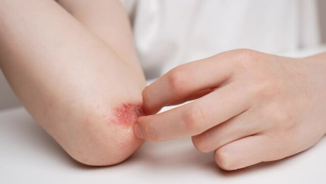 Child scratches reddened, inflamed areas with scabs on his elbow, close-up. Child suffers from attacks of allergies and dermatitis. Dermatological skin diseases concept