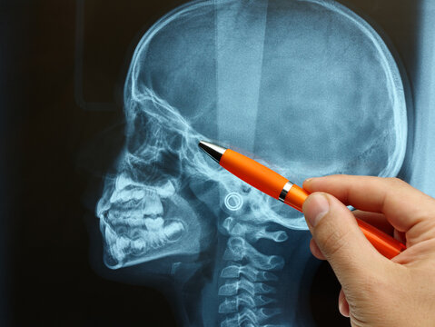 Closeup doctor examining and explaining x-ray image of a kid or child skull