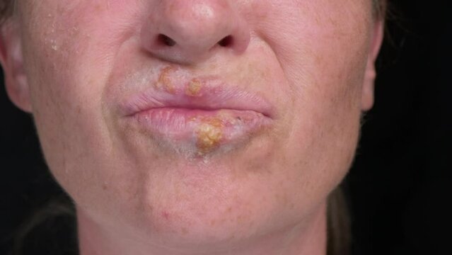 Herpes simplex on lips of woman close-up.