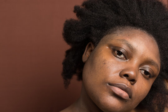 Brown skin woman with dark spots, hyperpigmentation on brown skin, african american woman with skin blemishes, imperfect skin