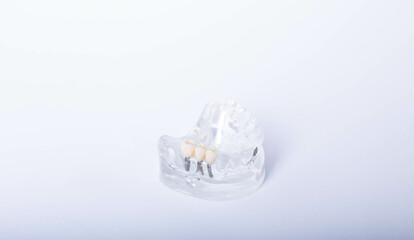 render of mandibular prosthesis all on 4 system supported by implants over white background