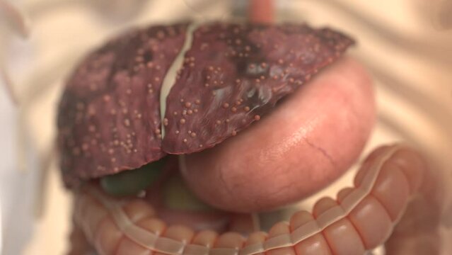 Liver cirrhosis formation animation video | Animated video of liver which turns from good to bad stage | Liver cirrhosis formation video HD