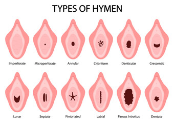 Different Types of Hymen shapes. Parous introitus Microperforate Lunar Septate Fimbriated Labial Crescentic Dentate Cribriform Denticular Aannular Imperforate. Medical procedure vector illustration.