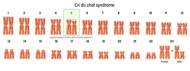 Karyotype of Cri du chat syndrome. Autosomal abnormalities. A partial deletion of the p arm of chromosome 5.