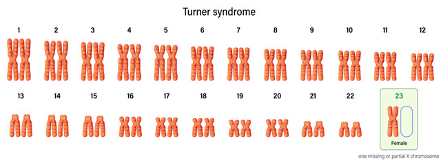 Karyotype of Turner syndrome. One of the X chromosomes (sex chromosomes) is missing or partially missing. 45,X, or 45,X0. Genetic disorder that affects females. - obrazy, fototapety, plakaty