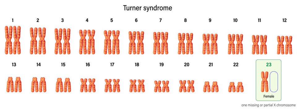 Karyotype of Turner syndrome. One of the X chromosomes (sex chromosomes) is missing or partially missing. 45,X, or 45,X0. Genetic disorder that affects females.
