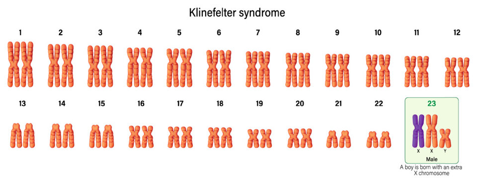 Karyotype of Klinefelter syndrome. Klinefelter's, KS or XXY. A genetic condition that results when a boy is born with an extra copy of the X chromosome.