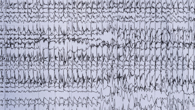 Imaging of ictal EEG recording in epilepsy patient.