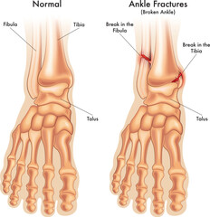 medical illustration compares a normal foot ankle, with a foot ankle fractured in two places, with annotations.