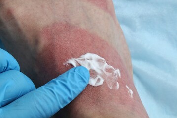 A doctor in blue gloves makes cream treatment on redness woman's leg as result of skin burn. Foot soreness after sunburn. Dermatology problems. Inflammation sensitive skin from allergies. Thermal burn