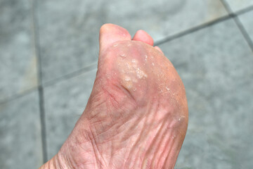 Outdoor Close-up. Floor tiles in background. Warts on sole of foot of a white man, about 60 years old, due to a visit to a unhygienic sauna or public swimming pool    