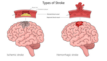 Human ischemic stroke and hemorrhagic stroke in human brain anatomy structure diagram hand drawn schematic vector illustration. Medical science educational illustration - obrazy, fototapety, plakaty
