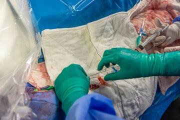 Heart stent placement process in operating room. Heart doctor inserting central venous catheter,...