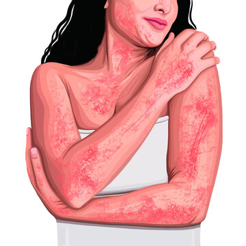 Woman with itchy, inflamed, sensitive skin, atopic dermatitis, eczema hugging herself 