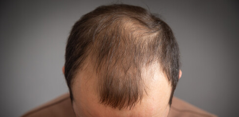 Caucasian man. Hair loss problem - 773706975