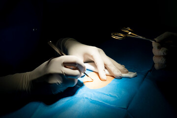 doctor and hospital staff in the operating room, detail of hands with surgical gloves passing...