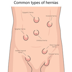 Human various hernia types on human abdomen for health and medical studies structure diagram hand drawn schematic vector illustration. Medical science educational illustration