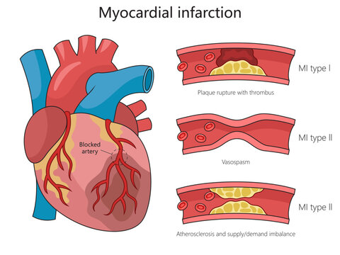 Human heart anatomy and different types of myocardial infarction for educational purposes structure diagram hand drawn schematic vector illustration. Medical science educational illustration