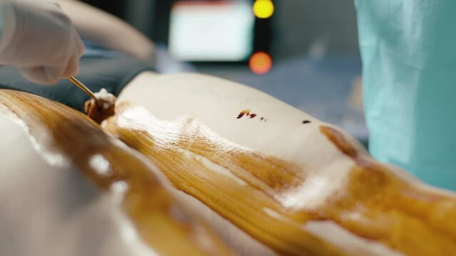 Doctor in blue coat and white gloves smears iodine on the leg before vein surgery