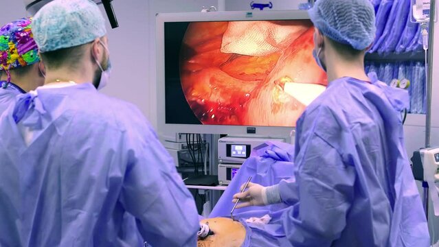 Instrument for laparoscopic surgery. A surgeon performs an operation using an endoscope on the stomach in a modern operating room.